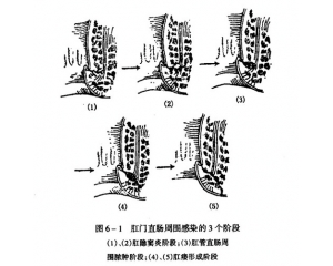 肛窦炎是什么病